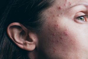 Foliculite no rosto: O que é e como tratar essa inflamação